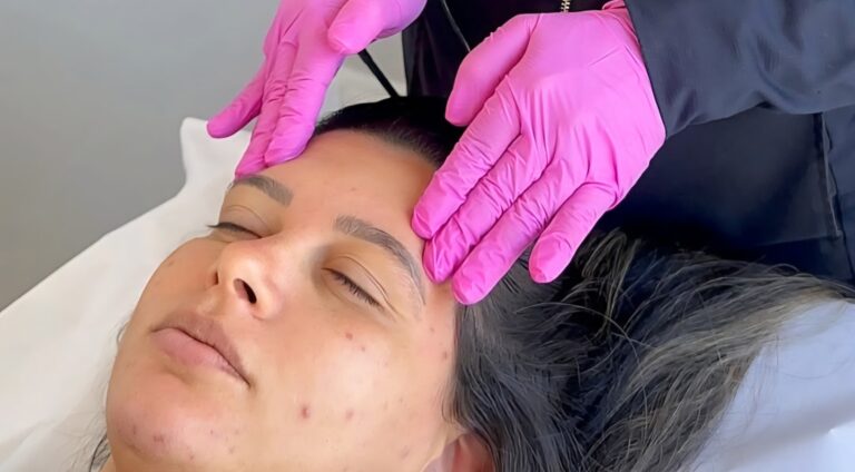 PRX - A evolução dos Bioestimuladores injetáveis e dos Peelings convencionais